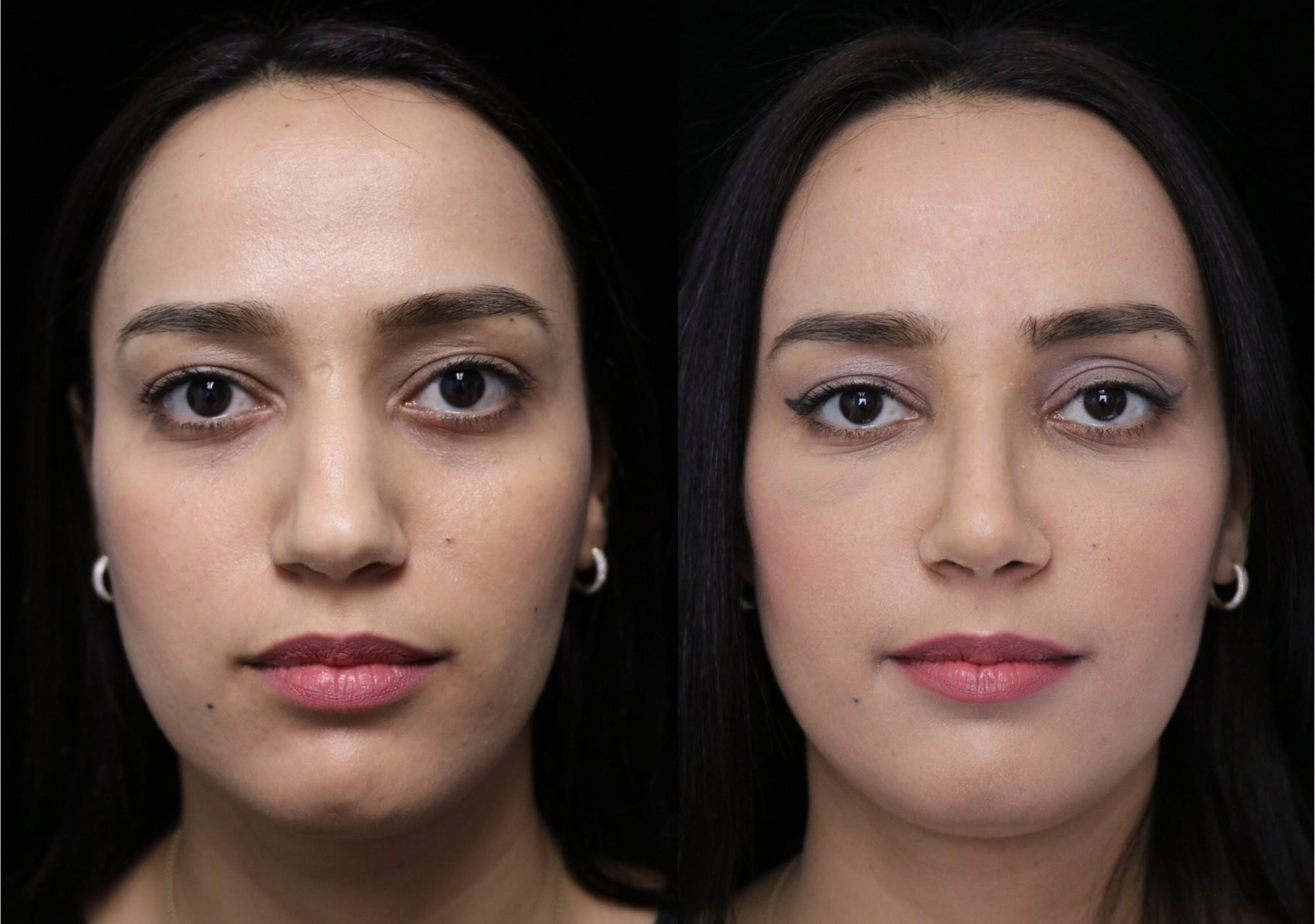 best rhinoplasty surgeons