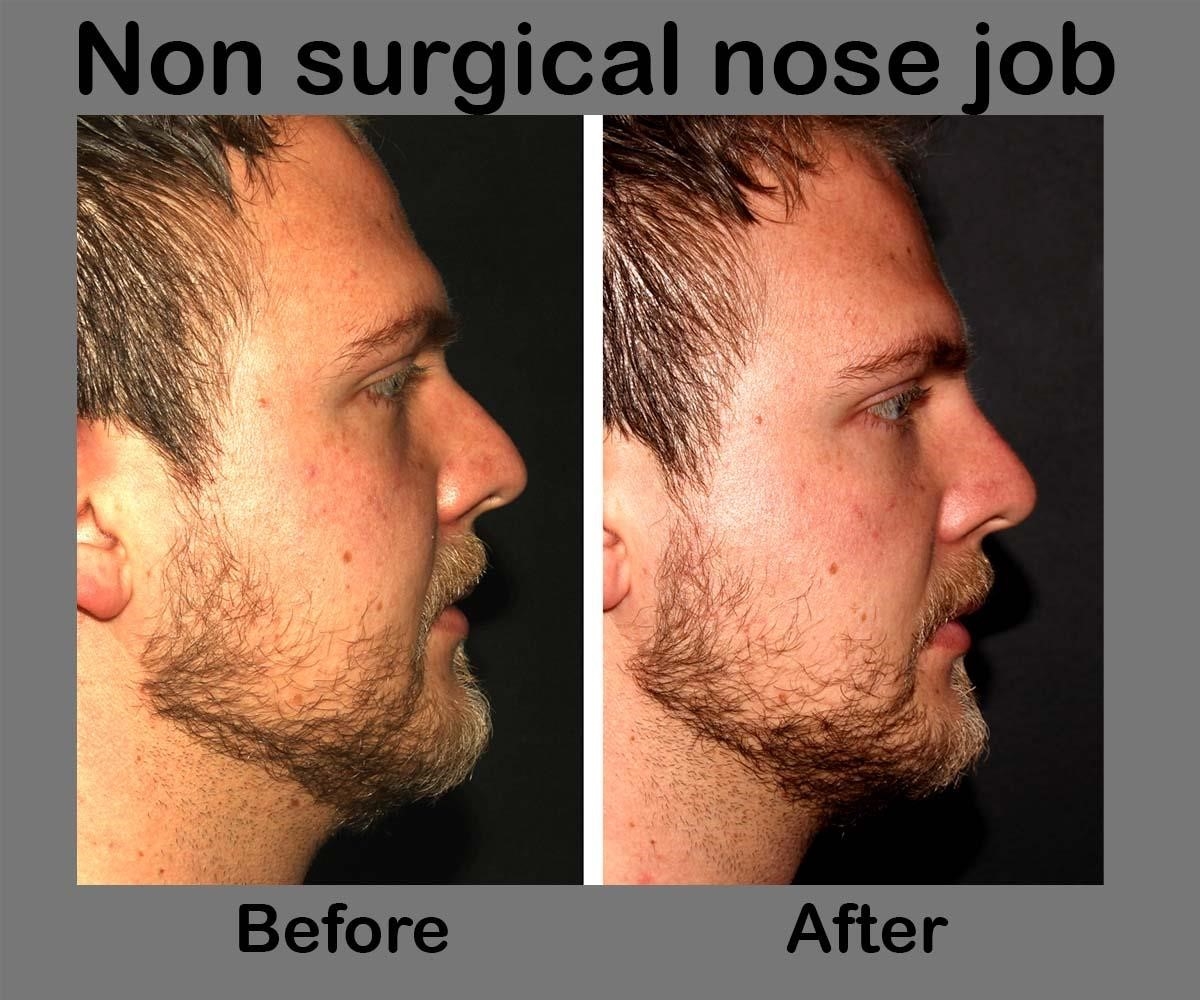 best rhinoplasty surgeons